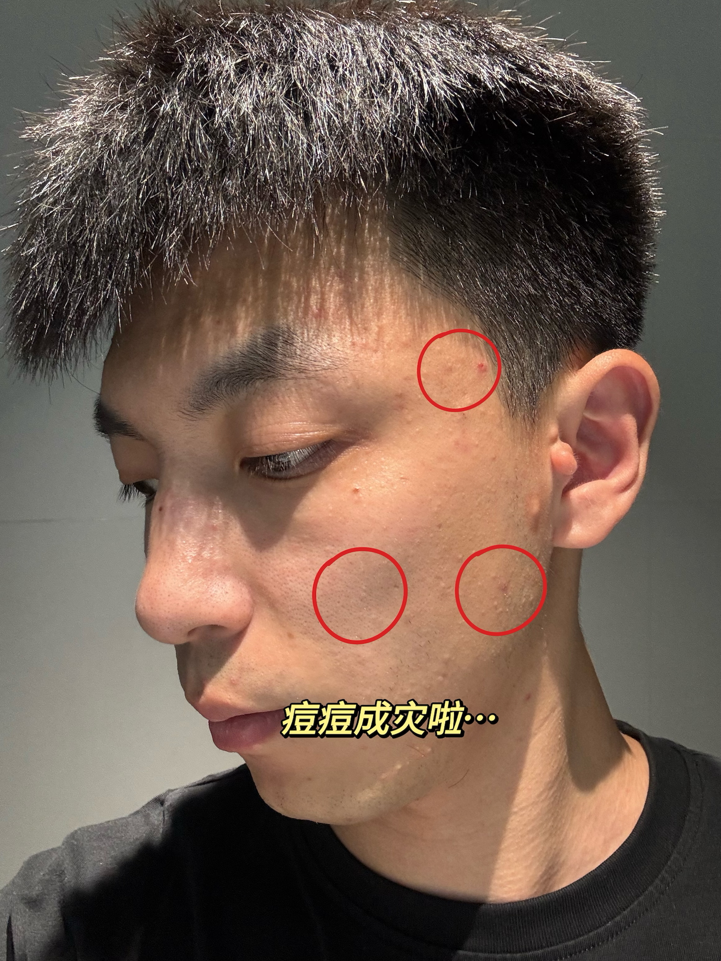 飞机打多了脸上会长痘痘吗(禁欲多久脸上痘痘没了)