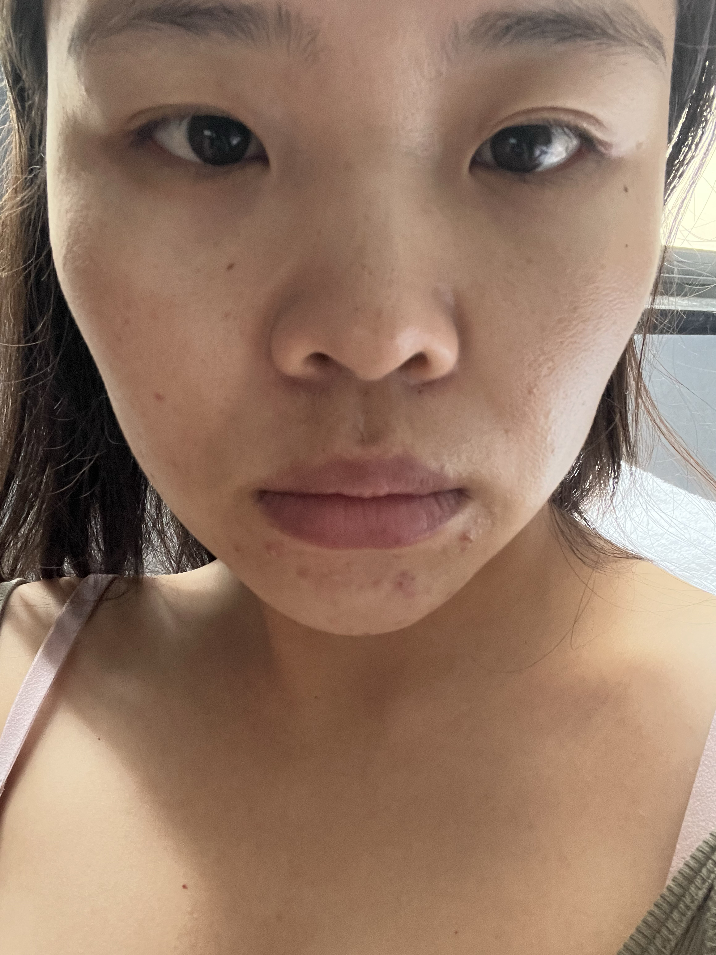 飞机打多了脸上会长痘痘吗(禁欲多久脸上痘痘没了)