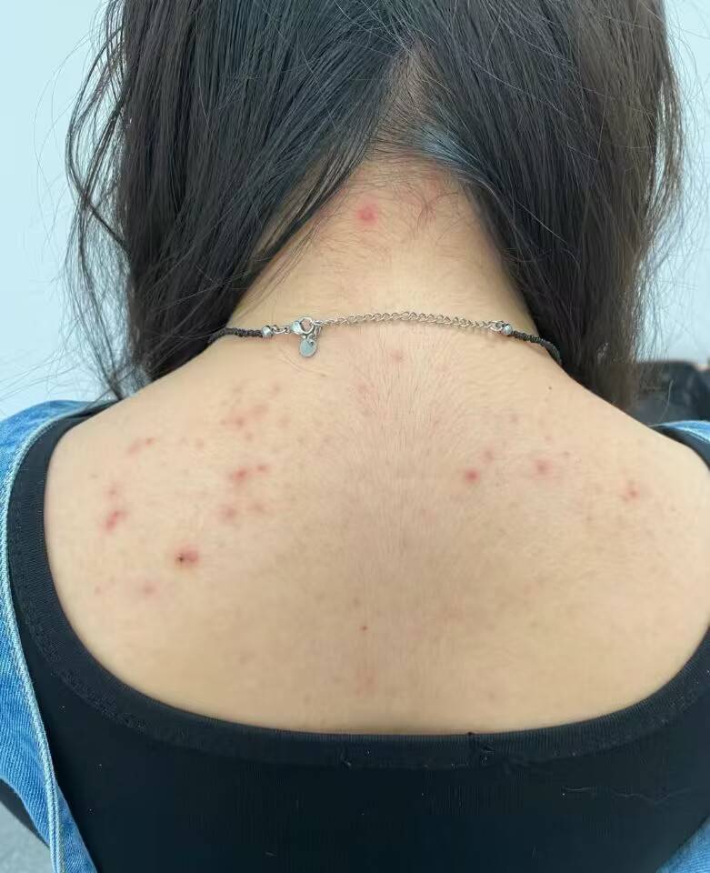 后背痘痘(后背痘痘多怎么回事)