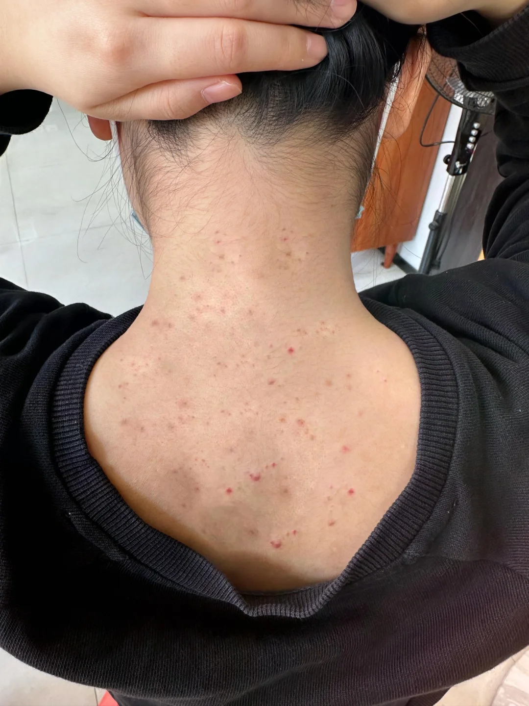 后背痘痘(后背痘痘多怎么回事)