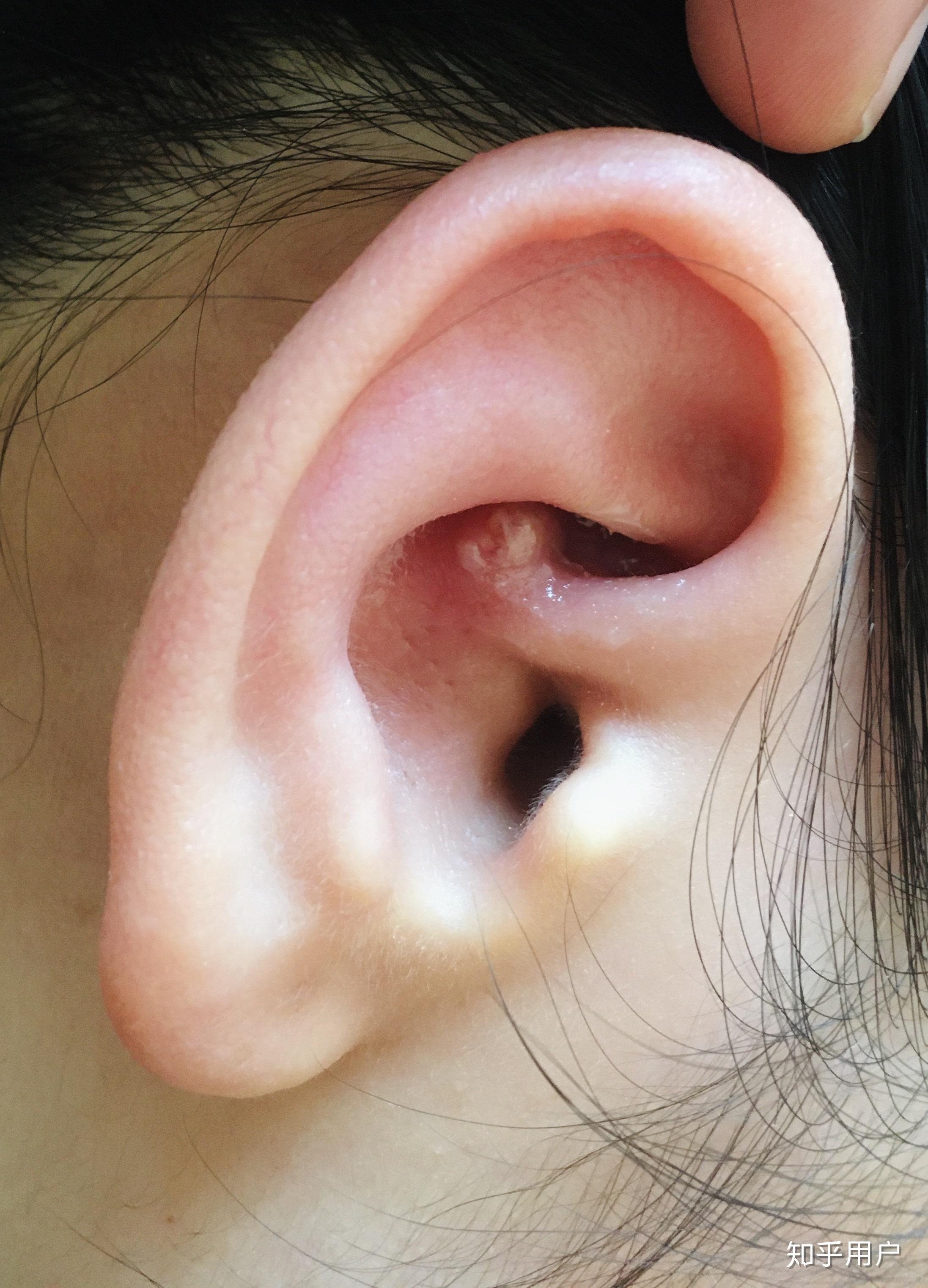 耳朵里面长痘痘(耳朵里面长痘痘的图片)