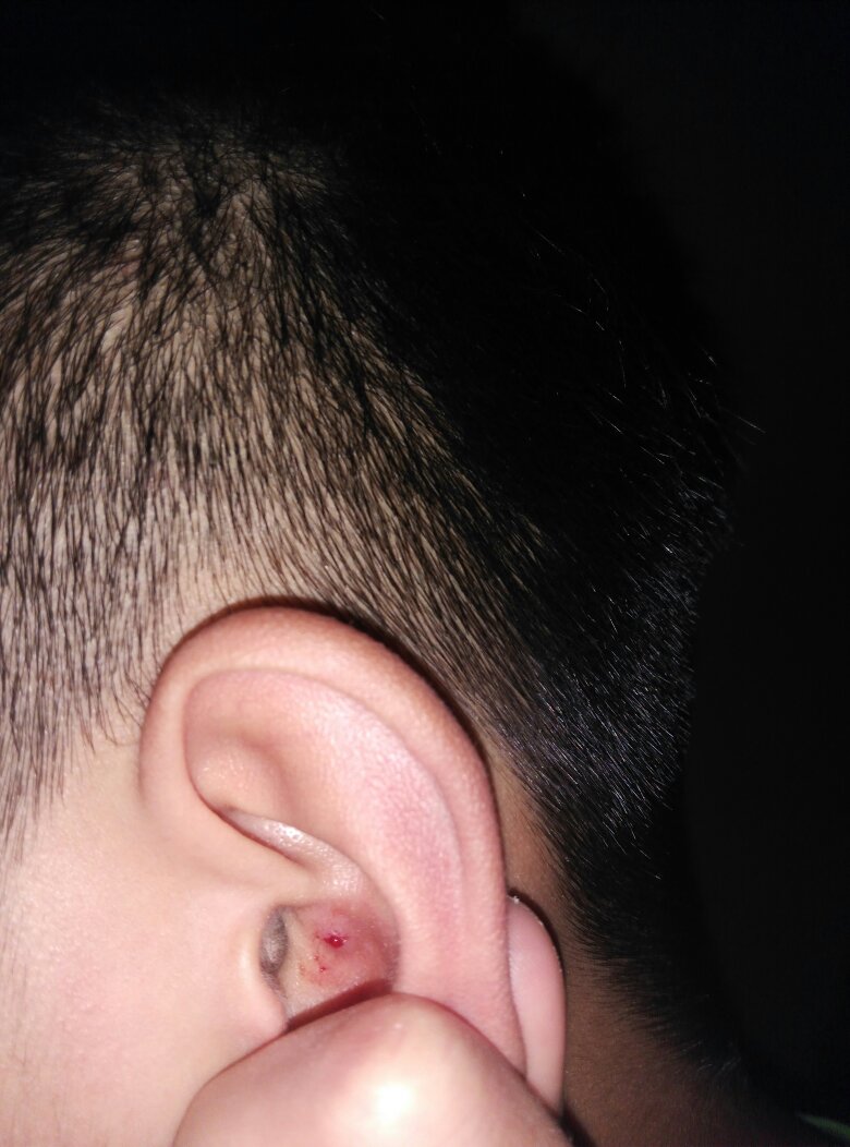 耳朵里面长痘痘(耳朵里面长痘痘的图片)