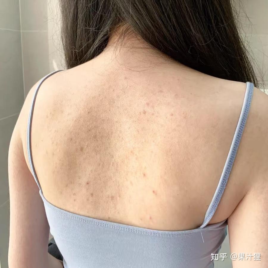 后背长痘痘(后背长痘痘是什么原因引起的)