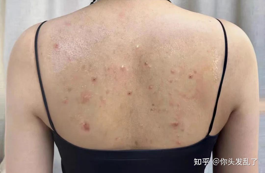 后背长痘痘(后背长痘痘是什么原因引起的)