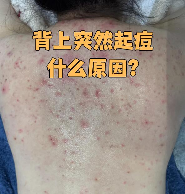 后背长很多痘痘是什么原因(后背长很多痘痘是什么原因图片)