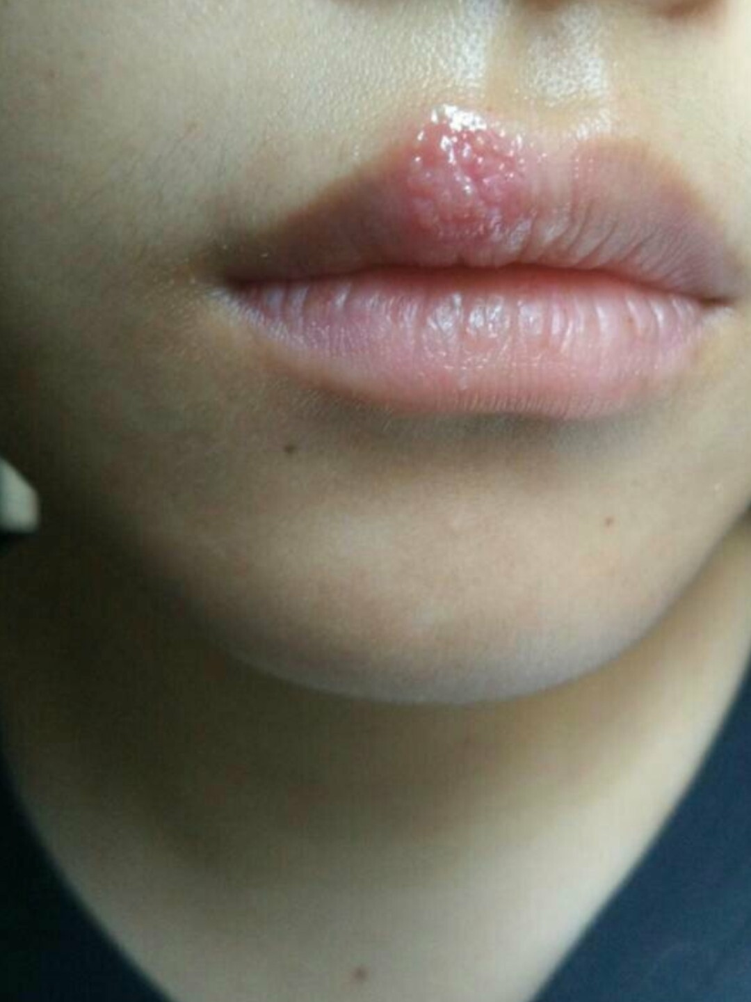 嘴上长痘痘(同房之后嘴上长痘痘)