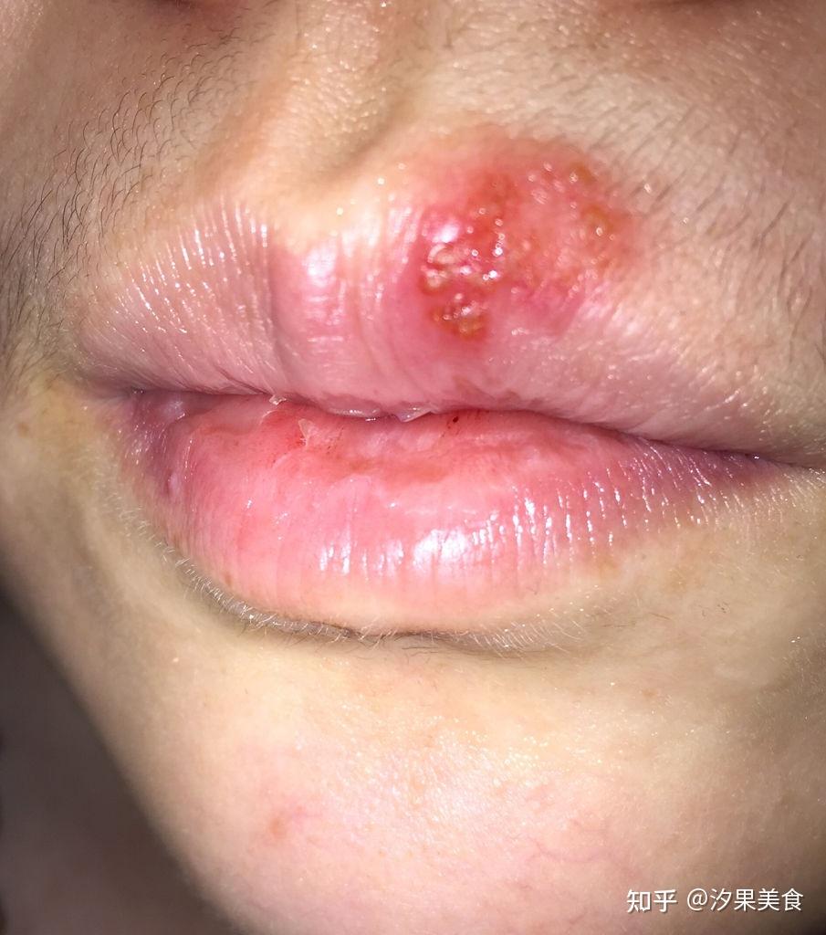 嘴上长痘痘(同房之后嘴上长痘痘)