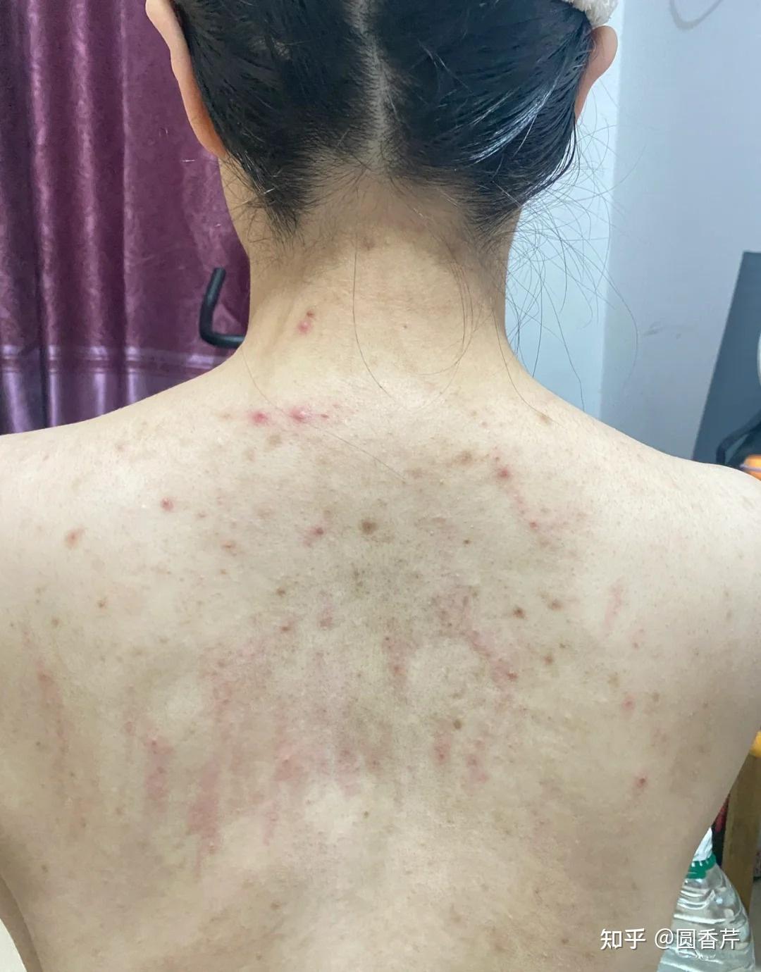 身上长痘痘(身上长痘痘还带有脓包是什么原因)