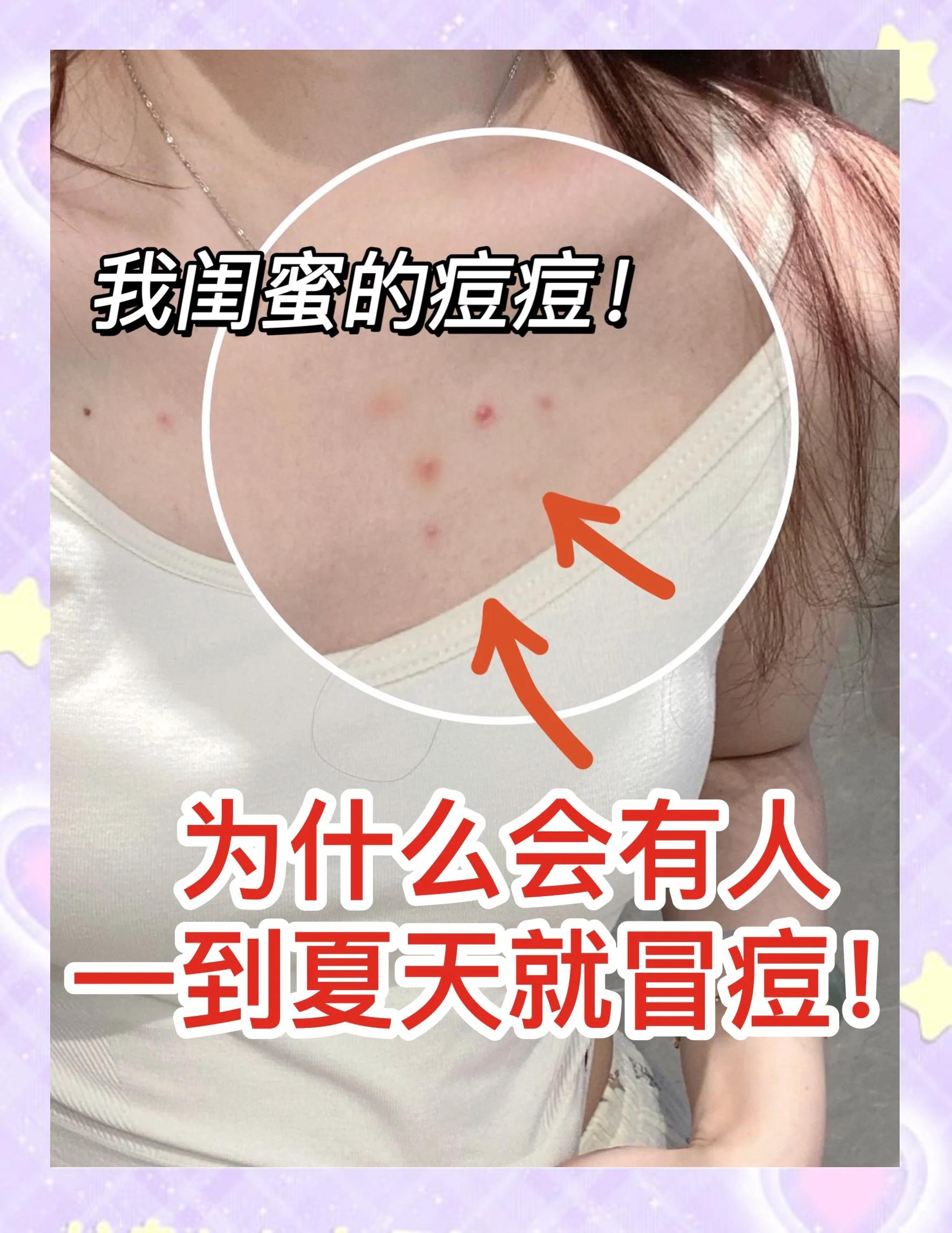 胸前长痘痘是什么原因引起的(胸前长痘痘是什么原因百度百科)