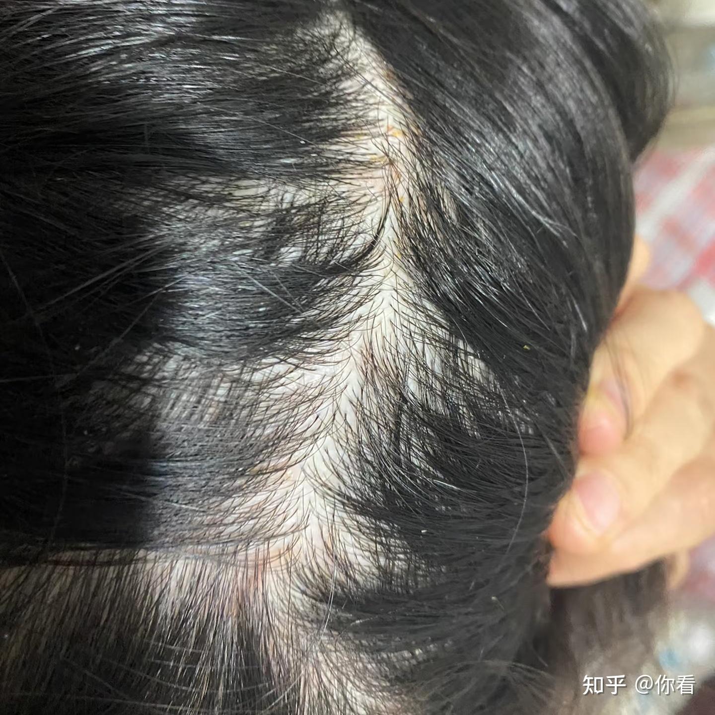 头发里面长痘痘是怎么回事(头发里面长痘痘是怎么回事一碰特疼)