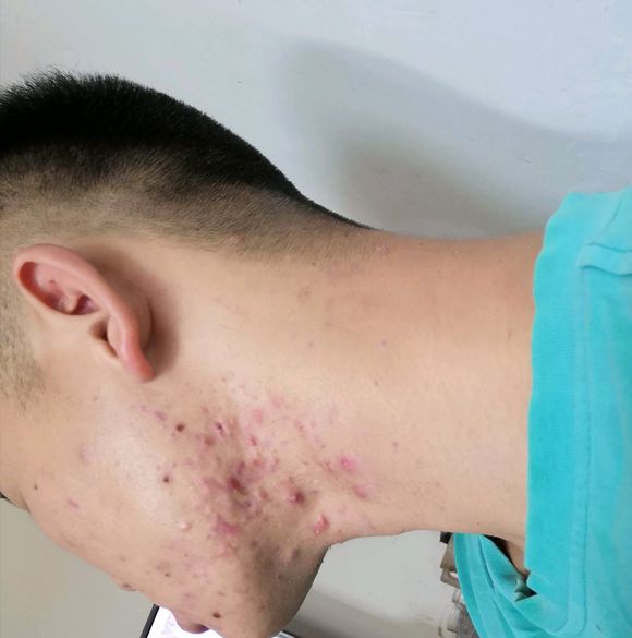 内分泌失调老长痘痘(内分泌失调老长痘痘挂什么科)