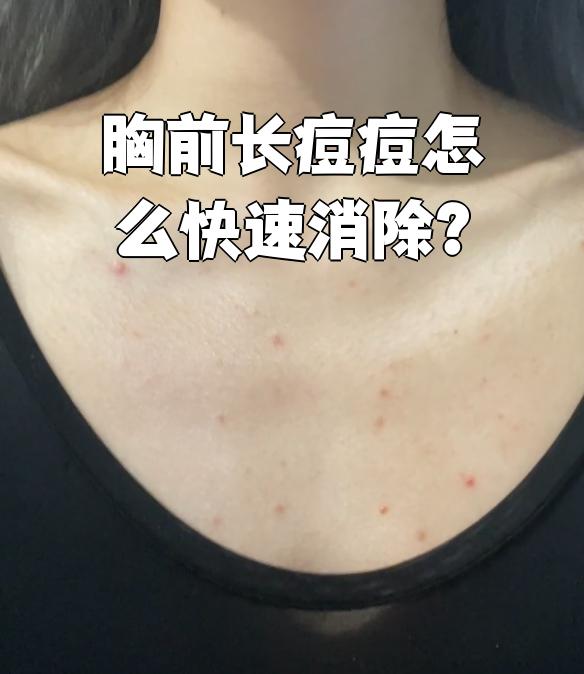胸上长痘痘怎么回事(乳房上长了脓包型痘痘)