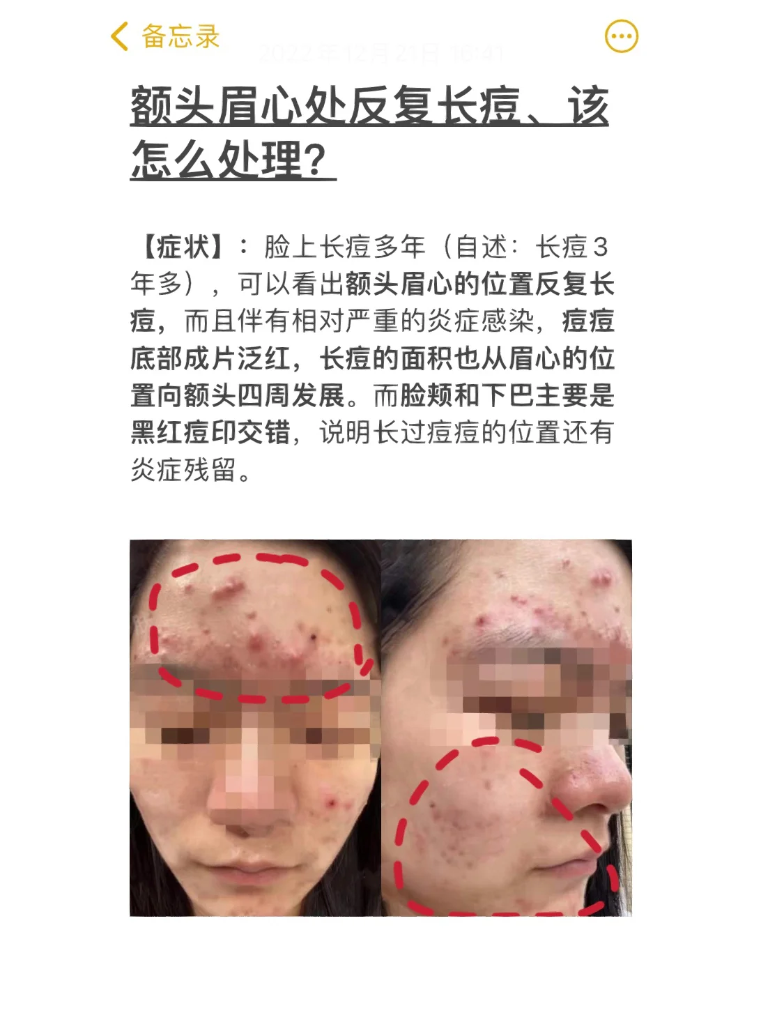 眉毛上长痘痘(眉毛上长痘痘有什么寓意)