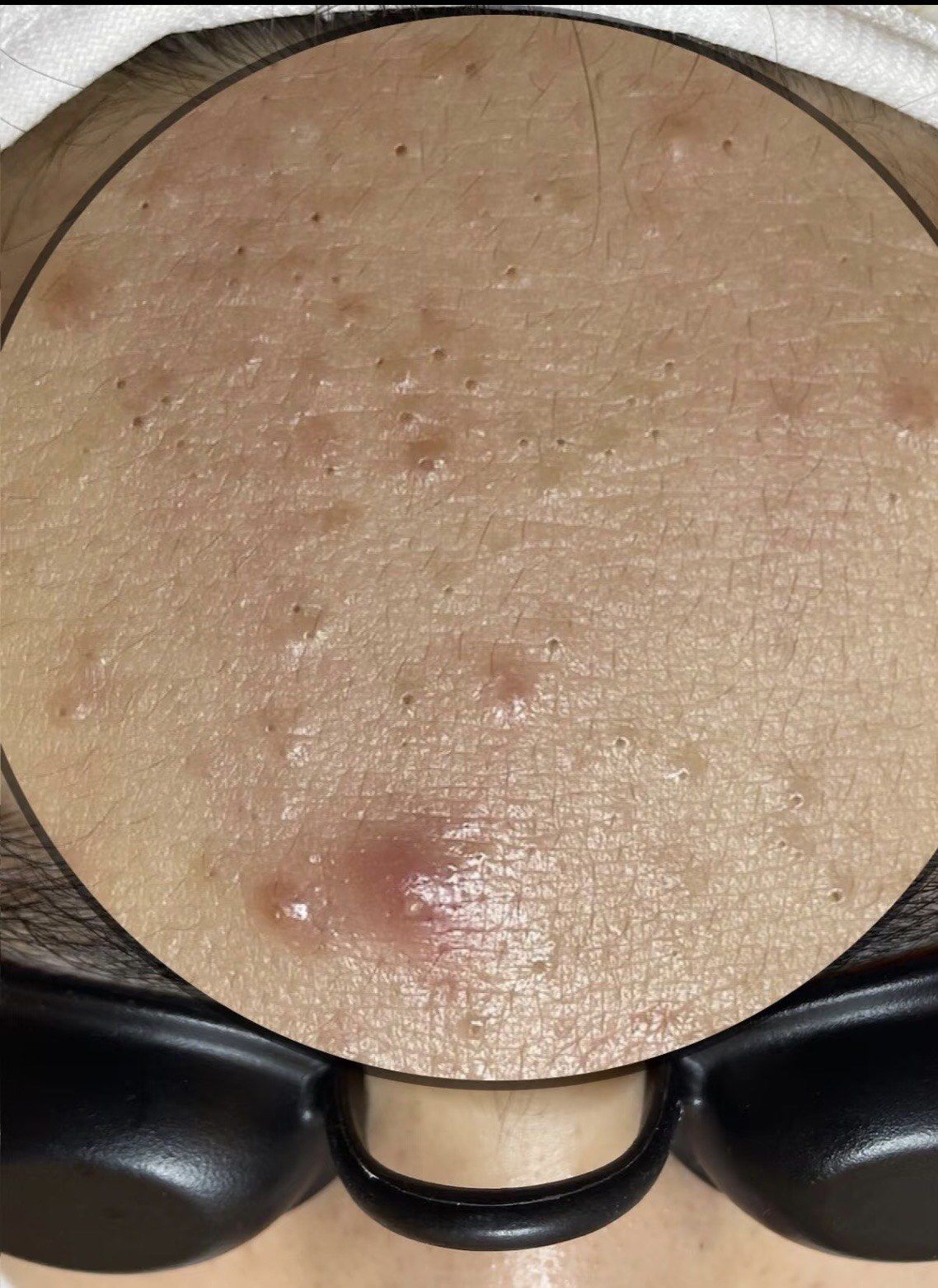 痘痘挤出血算干净了吗(痘痘 挤出血)