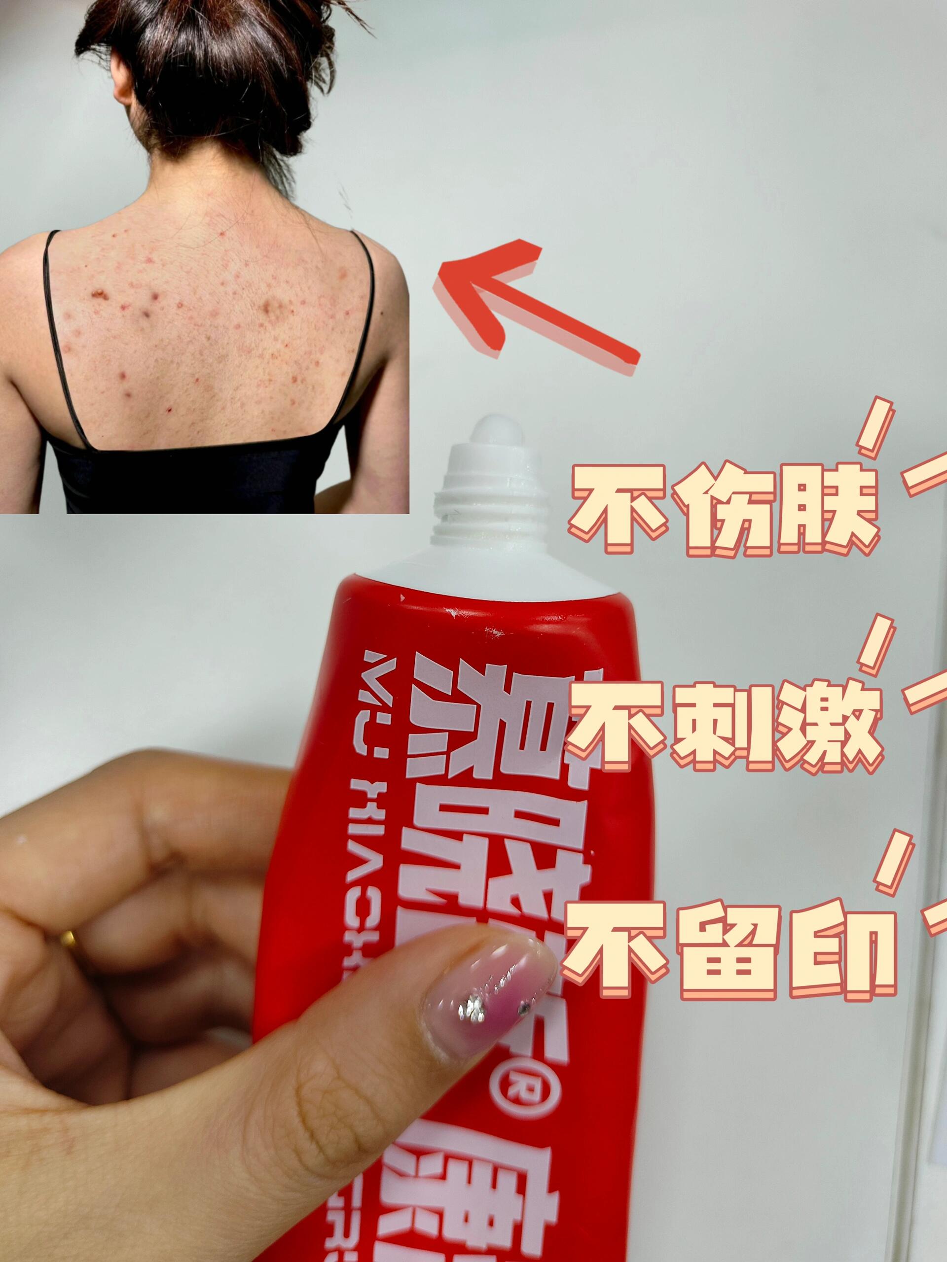 脸上长红色的痘痘是什么原因(脸上长红色的痘痘是什么原因中医)