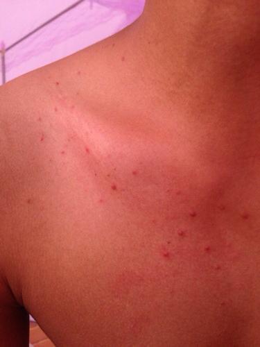 脸上长红色的痘痘是什么原因(脸上长红色的痘痘是什么原因中医)