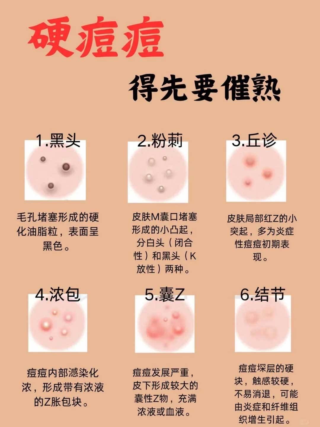 唇周围长痘痘是什么原因(男生唇周围长痘痘是什么原因)