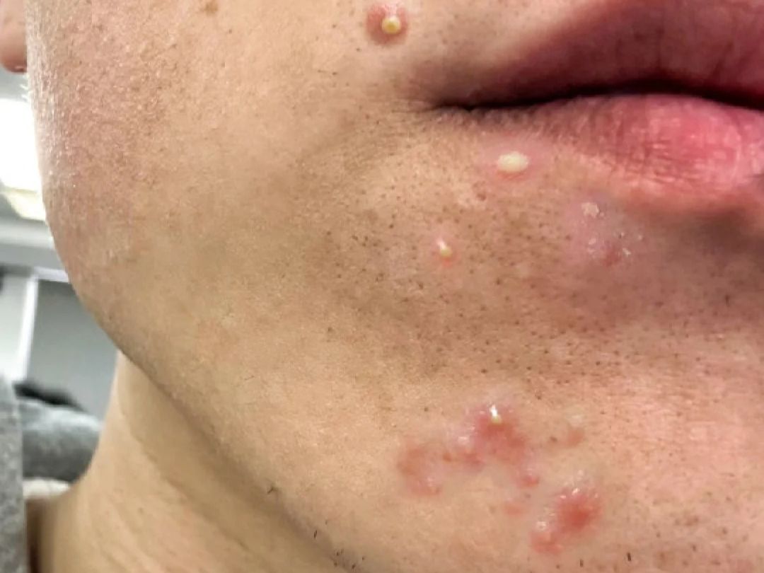 下巴长痘痘(下巴长痘痘是因为什么原因引起的)