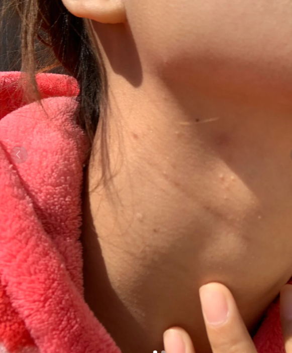 脖子长痘痘(脖子长痘痘用什么药膏)