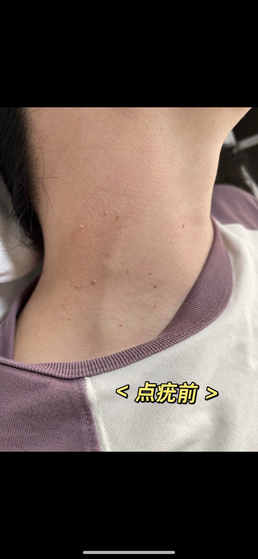 脖子上长痘痘是什么原因(后背脖子上长痘痘是什么原因)