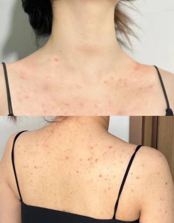 后背长痘痘是螨虫吗(后背长痘痘是螨虫吗图片)