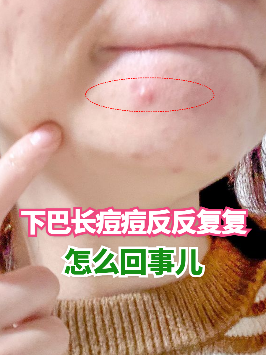 痘痘反反复复(头上一直长痘痘反反复复)