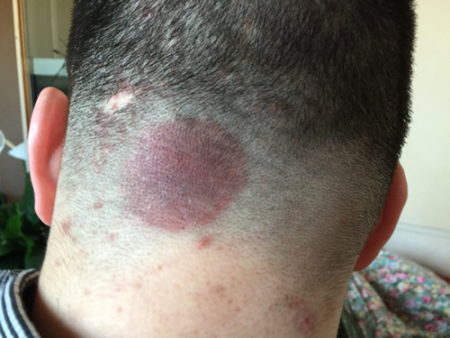 后脑勺长痘痘怎么回事(后脑勺长痘痘怎么回事?)