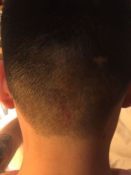 后脑勺长痘痘怎么回事(后脑勺长痘痘怎么回事?)