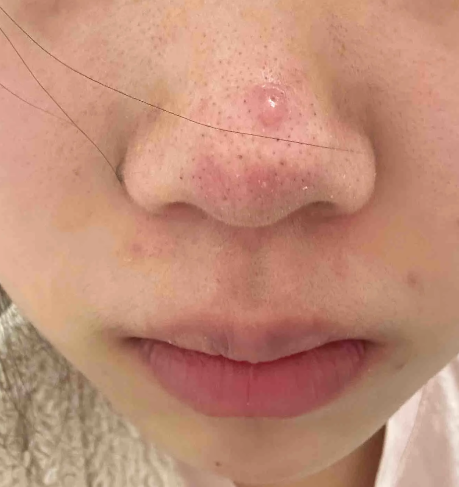 鼻子上长痘痘是怎么回事(鼻子老长痘痘是怎么回事)