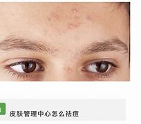 阴唇上长了一个痘痘(hpv痘痘长啥样子图)