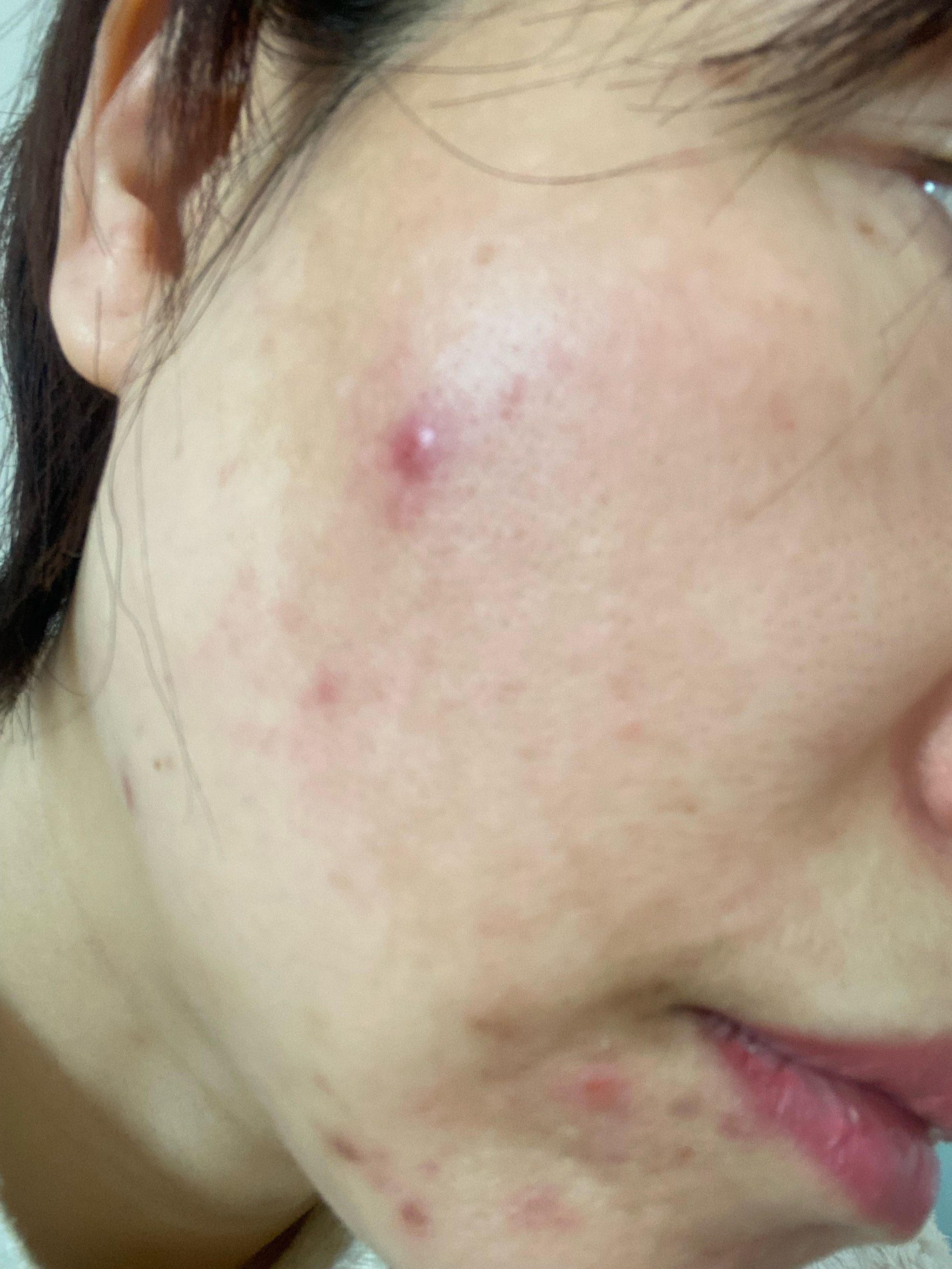 痘痘图片(痘痘图片前后对比)