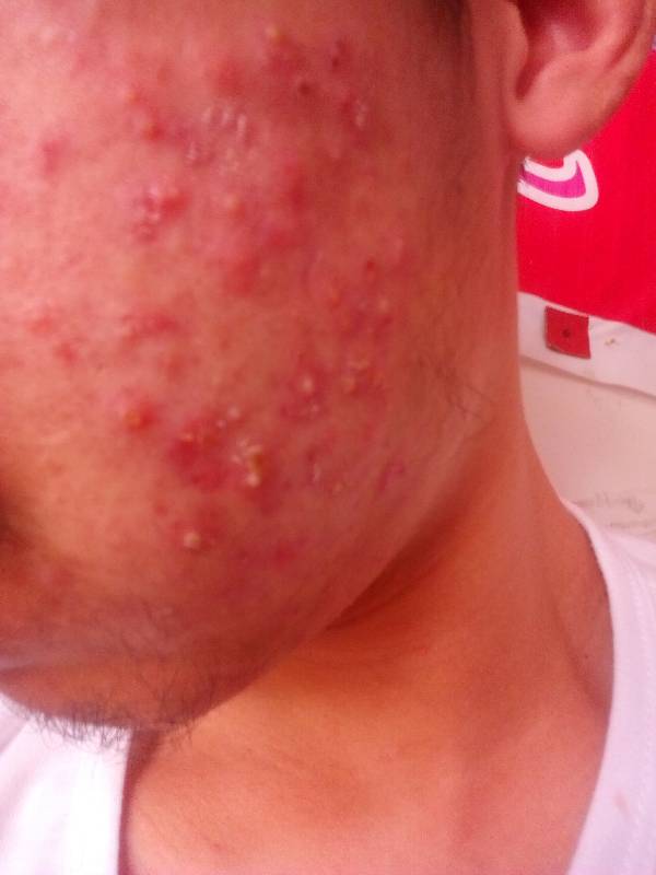 胸口有红色的小痘痘(胸口有红色的小痘痘可用什么药膏)