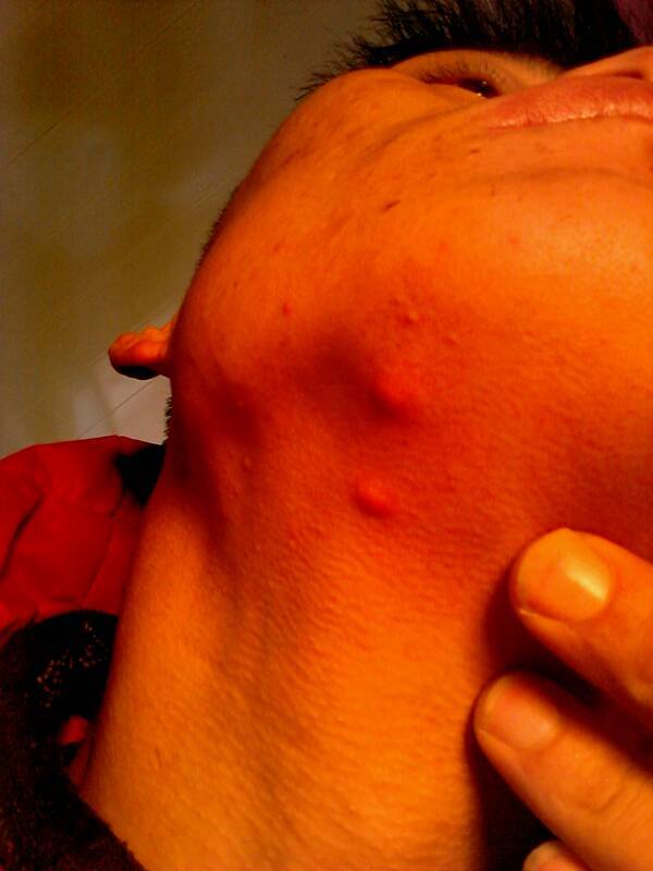 胸口有红色的小痘痘(胸口有红色的小痘痘可用什么药膏)