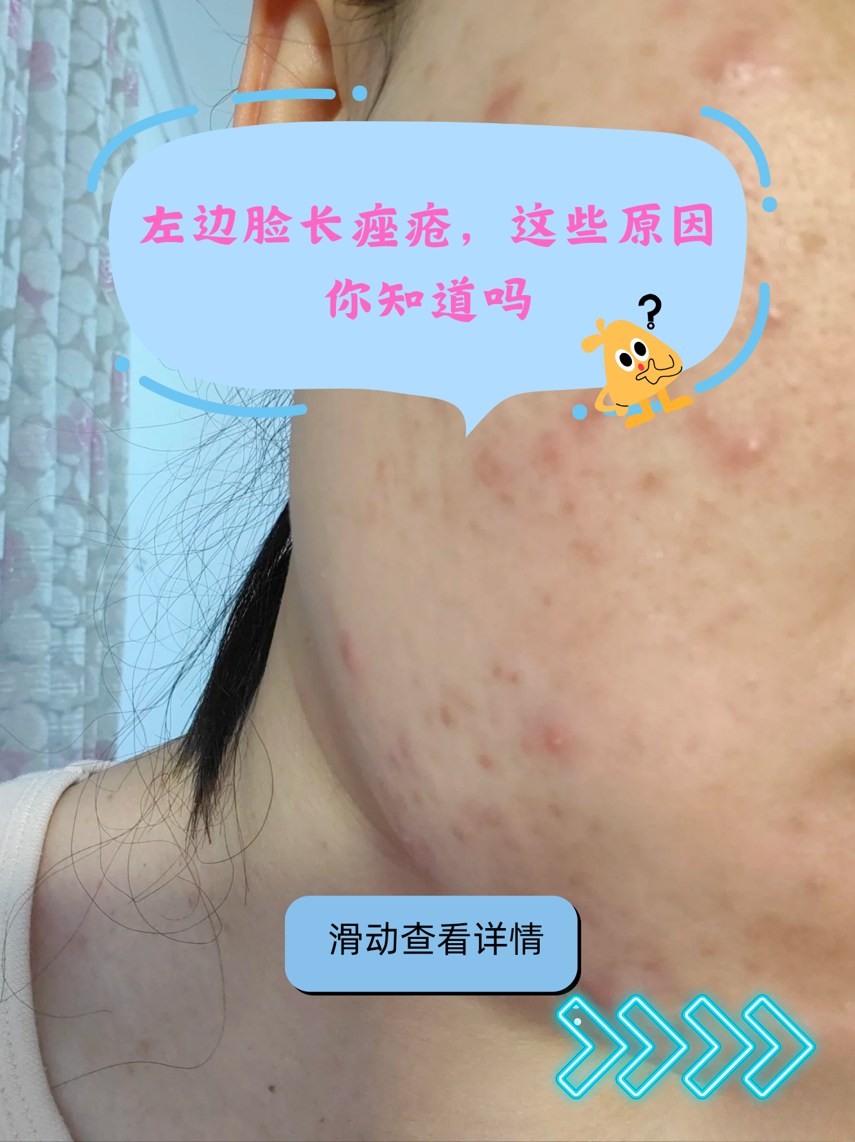 脸颊两侧长痘痘什么原因(男生脸颊两侧长痘痘什么原因)