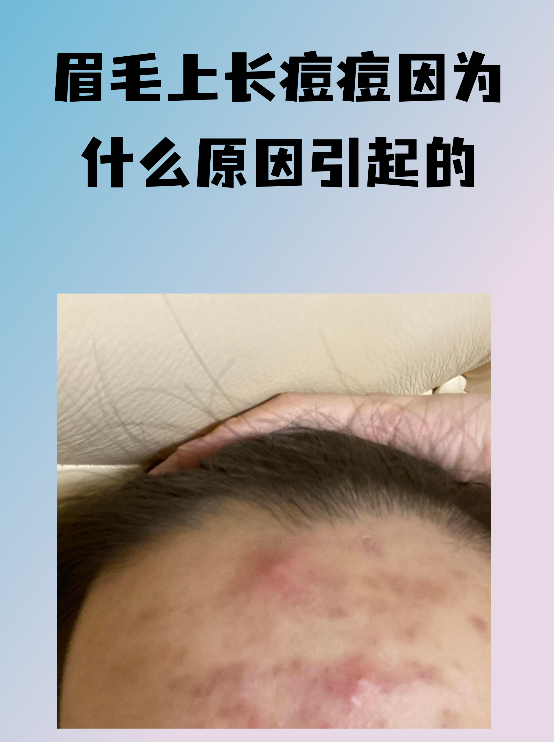 眉头长痘痘是因为什么原因引起的(眉头长痘痘是怎么回事啊)