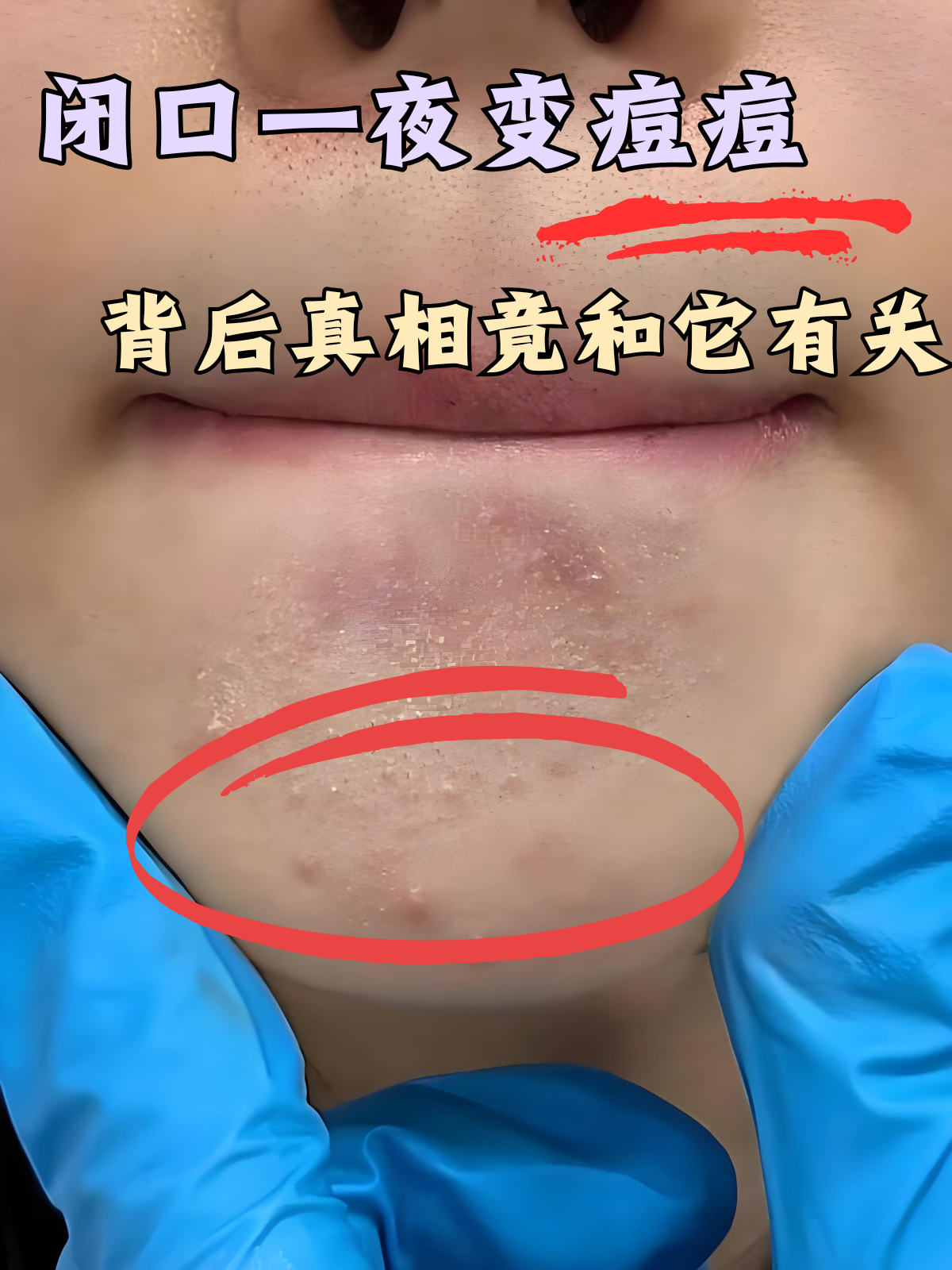 一夜快速消痘痘(扫一扫识别痘痘)