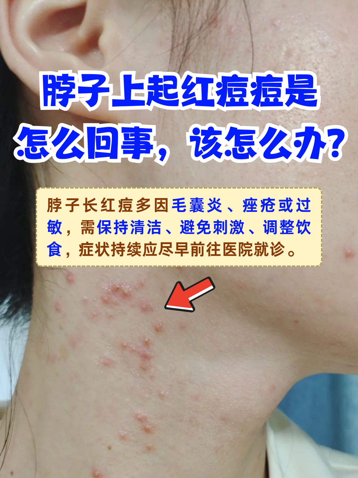 脖子上长痘痘是怎么回事(脖子上起小痘痘是怎么回事)