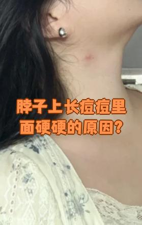 脖子上长痘痘是怎么回事(脖子上起小痘痘是怎么回事)