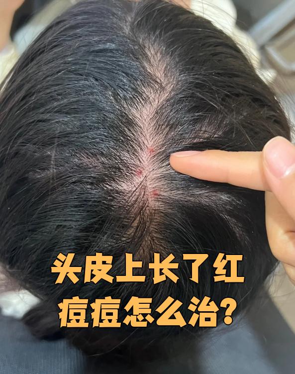 头皮长痘痘是怎么回事(头皮长痘痘是哪里的问题)