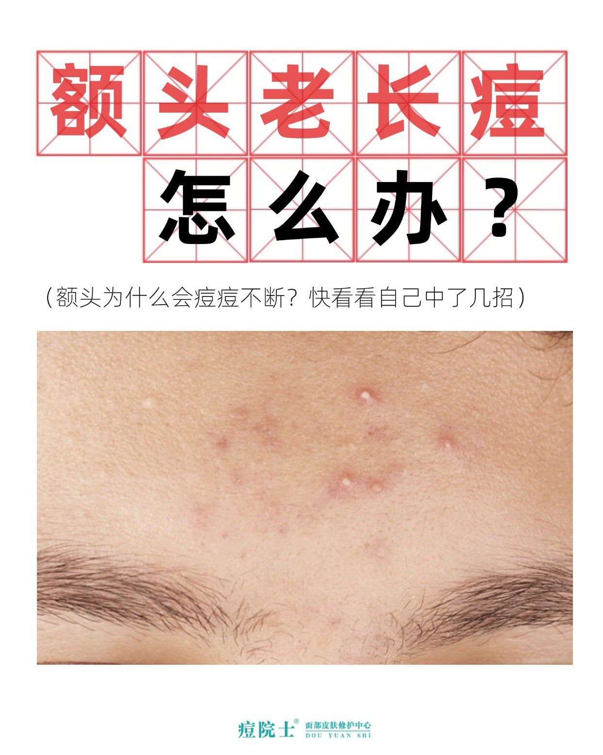 额头长痘痘怎么办(十二岁女生额头长痘痘怎么办)