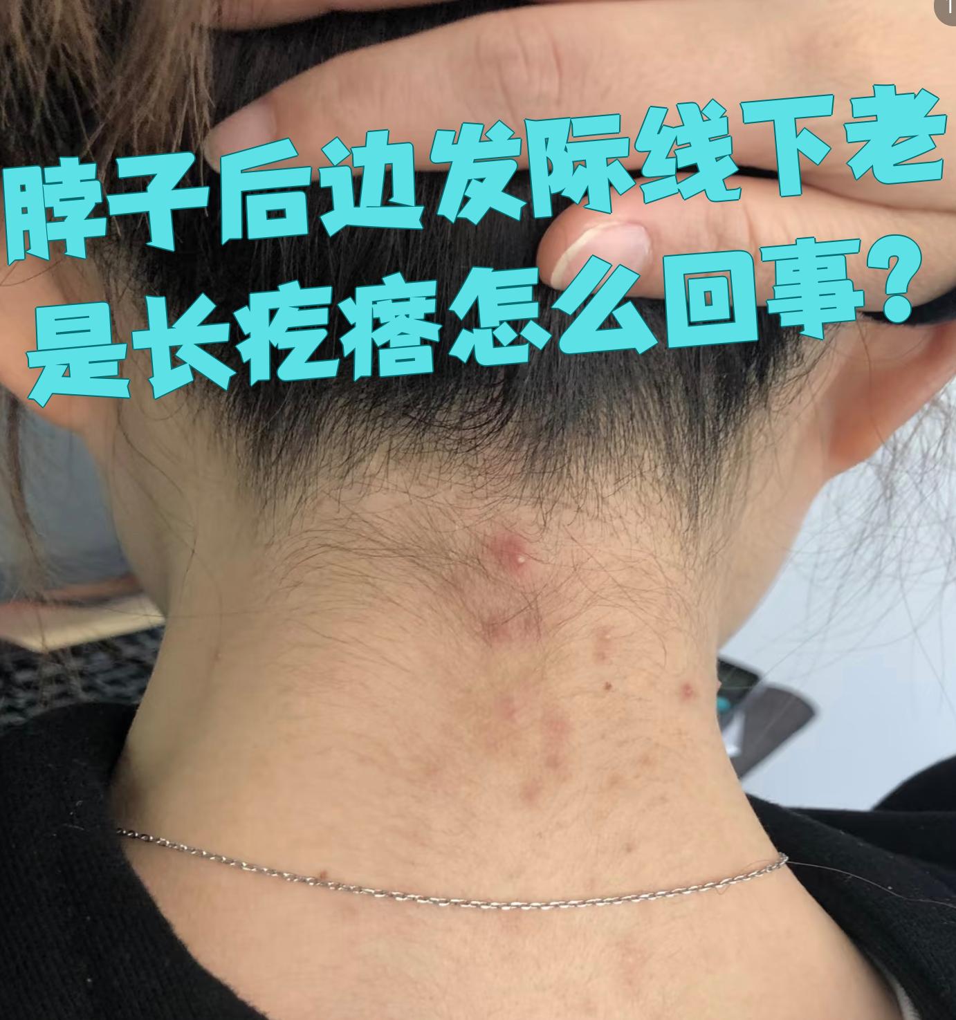 脖子后面长痘痘怎么回事(脖子下起痘痘是怎么回事)