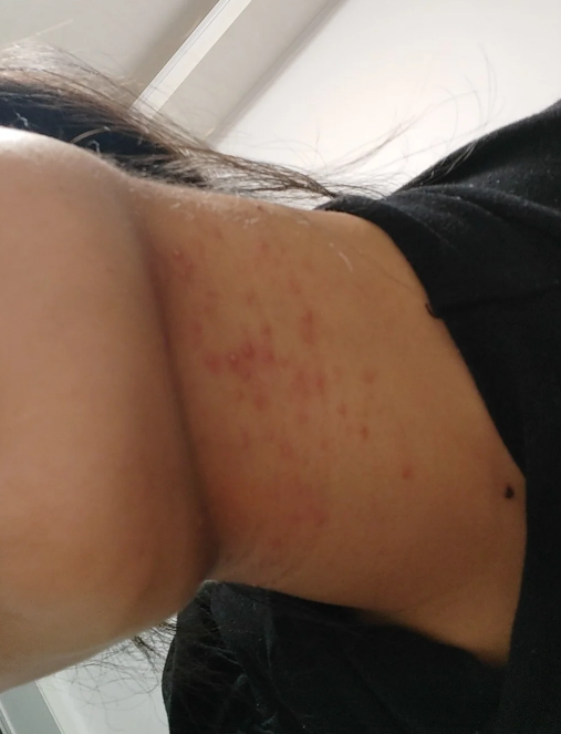 脖子长痘痘是怎么回事(后面脖子长痘痘是怎么回事)