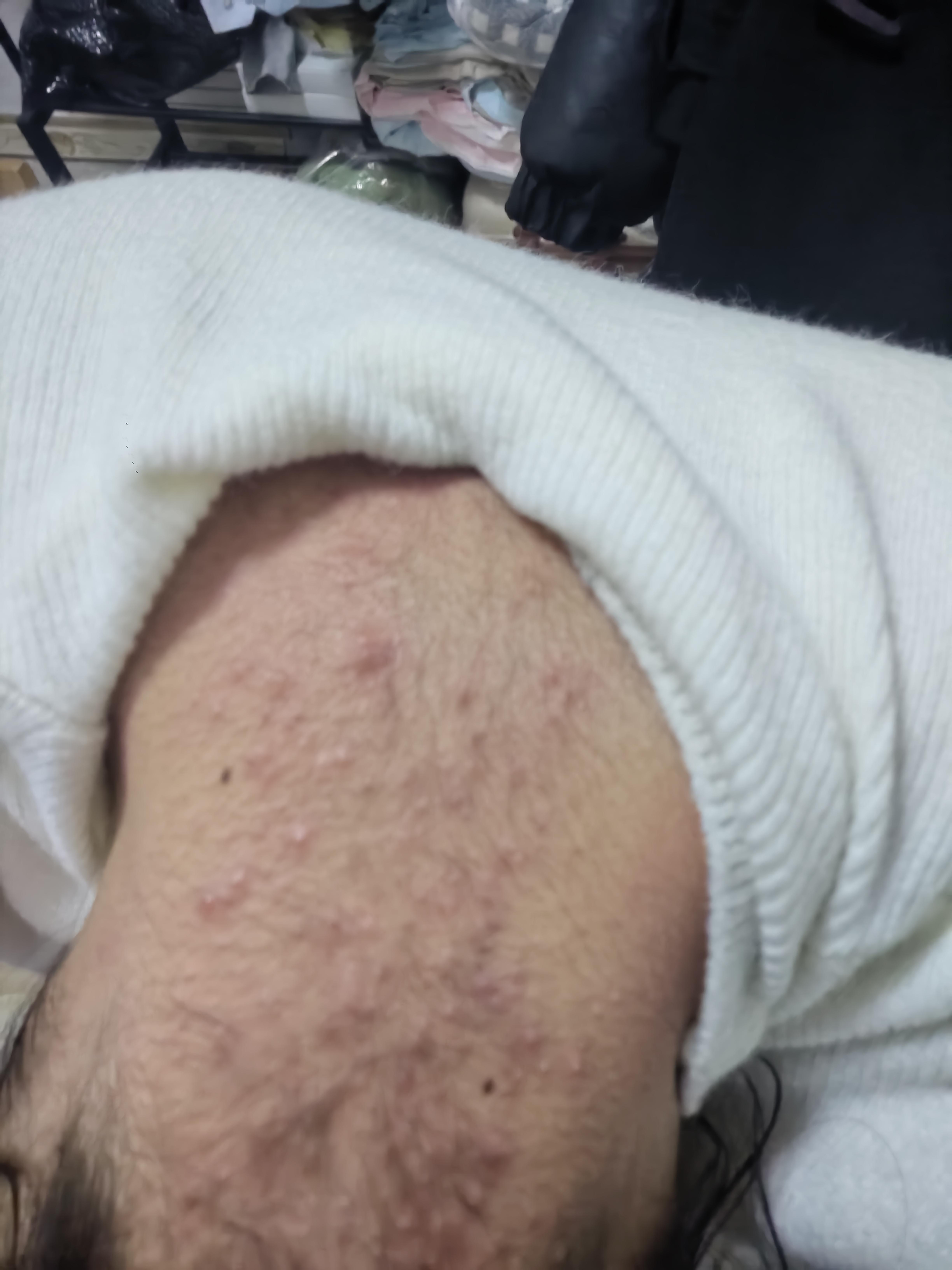 脖子后面长痘痘是什么原因(后脖子老是长痘痘怎么回事)