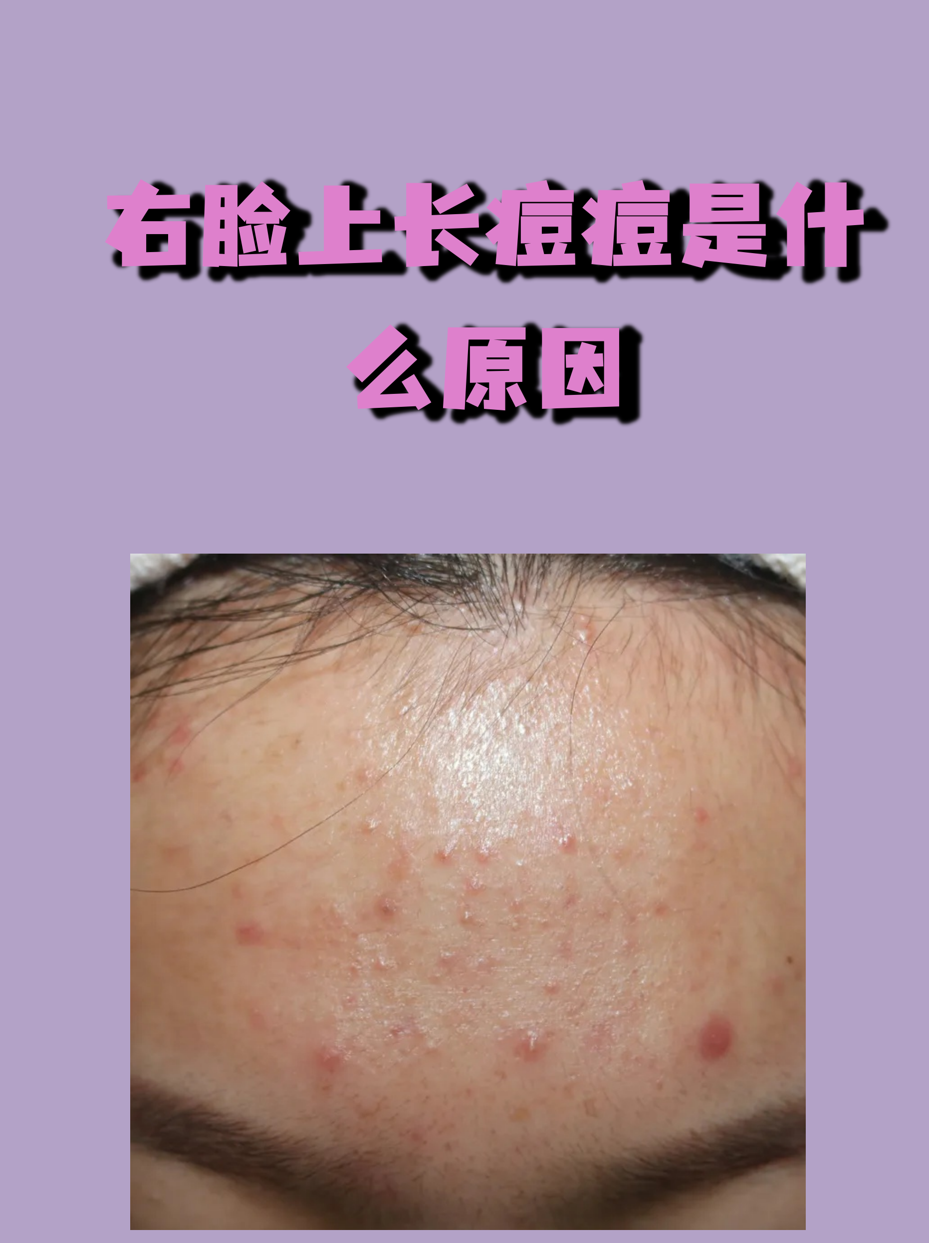 脸上长痘痘了(脸上长痘痘了擦什么药效果好)