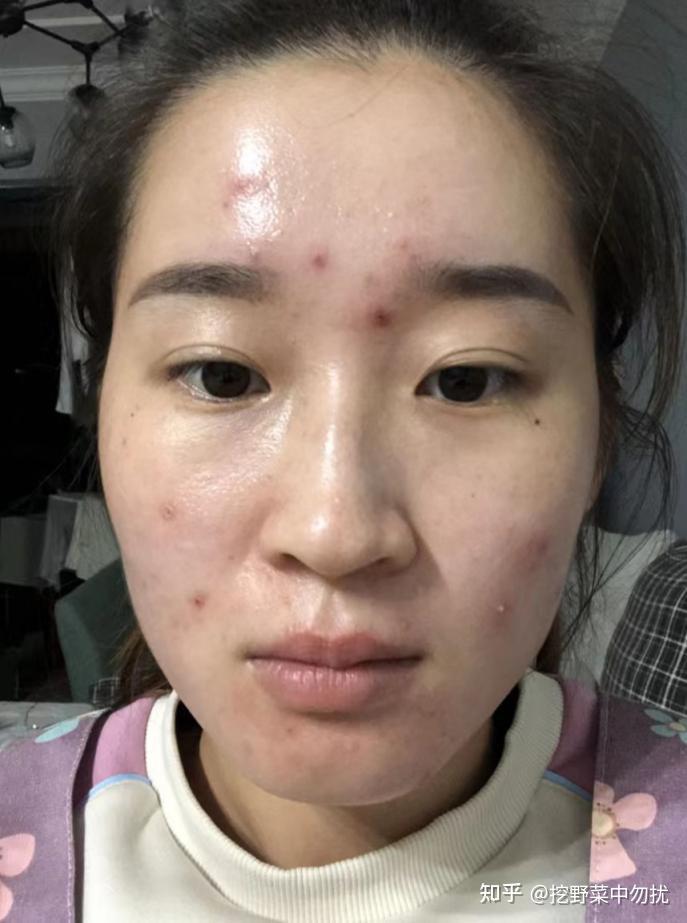 脸上长痘痘了(脸上长痘痘了擦什么药效果好)