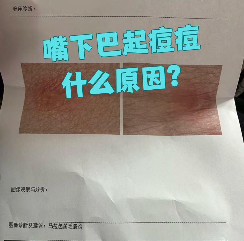 嘴下巴长痘痘怎么回事(嘴下巴长痘痘怎么回事吃什么)