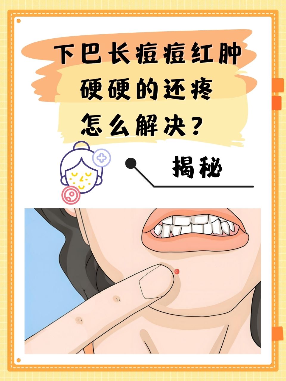 下巴长痘痘的原因(月经前一周下巴长痘痘的原因)