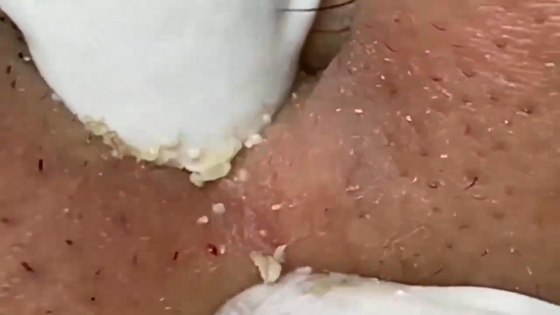 挤痘痘(挤痘痘颅内感染前兆)