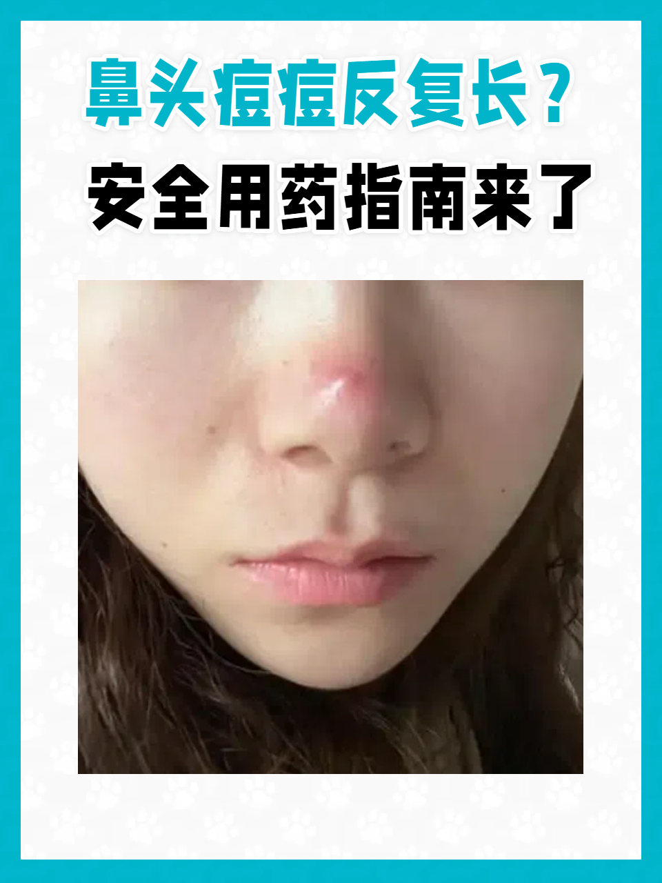 鼻子上长痘痘怎么办(鼻子上长痘痘怎么办摸着就痛)