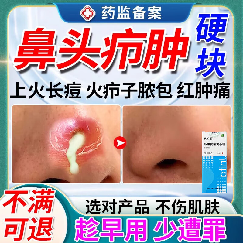 鼻子上长痘痘怎么办(鼻子上长痘痘怎么办摸着就痛)